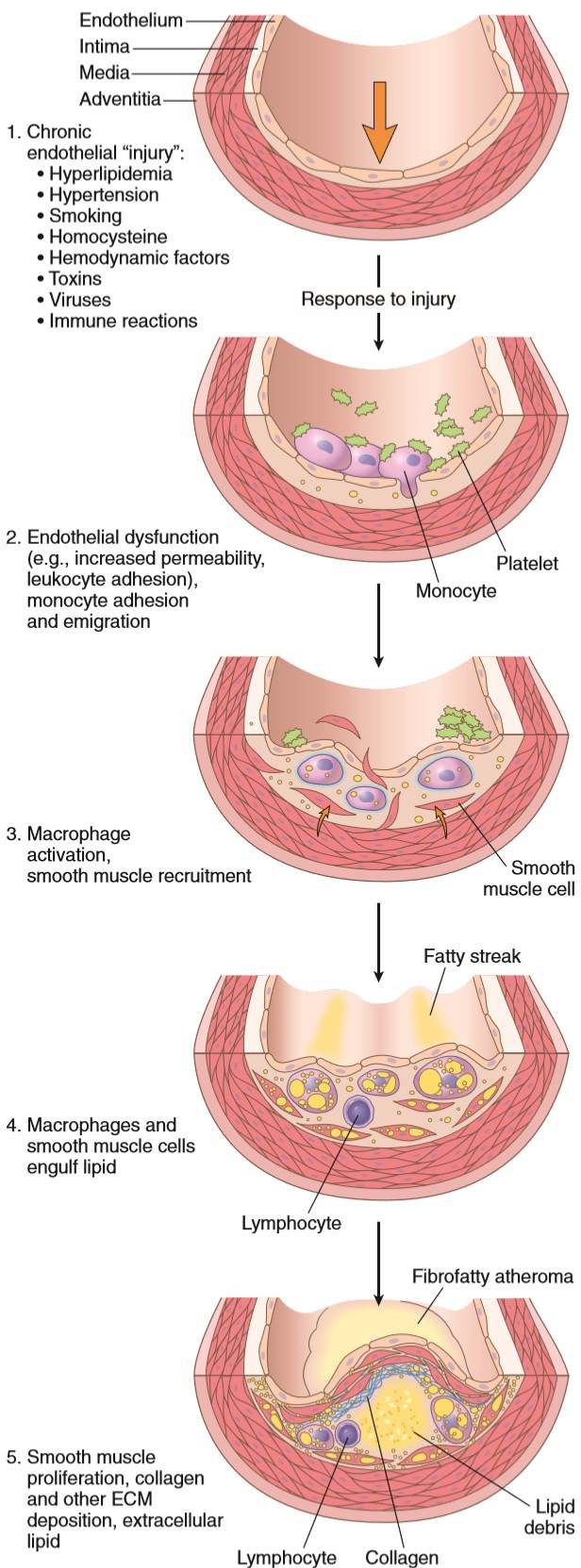 atherosclerosis pathophysiology