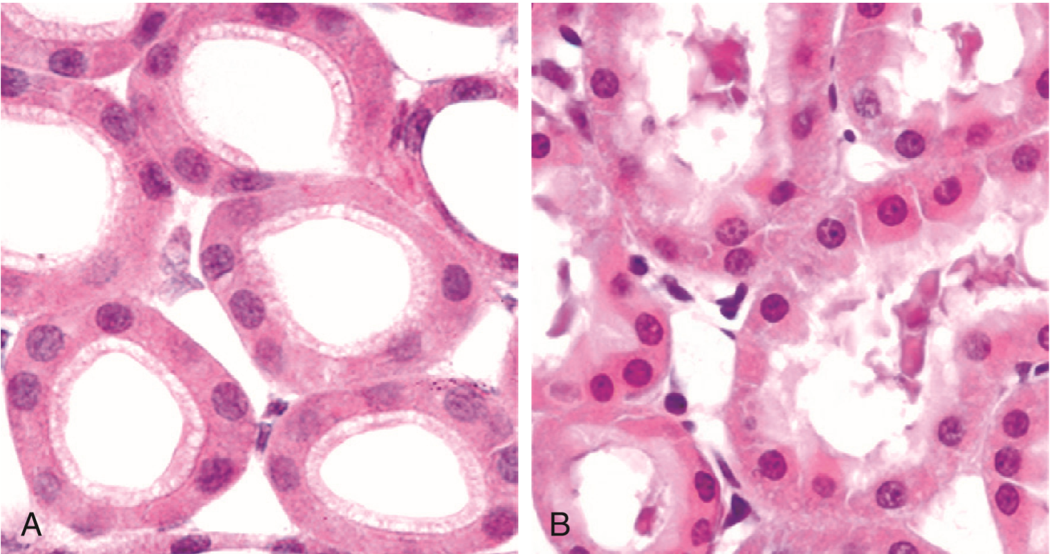 8 The Definition And Types Of Degenerations Parenchymal And Fatty Degeneration Organ Examples 7537