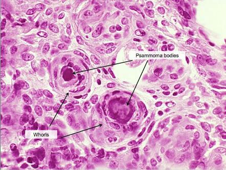 Bilderesultat for psammoma bodies