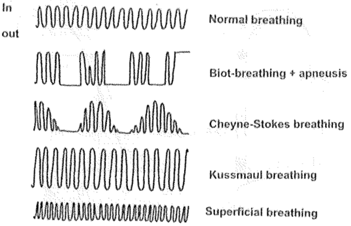 Tidal volume of some abnormal breathing patterns: a) Cheyne-Stokes