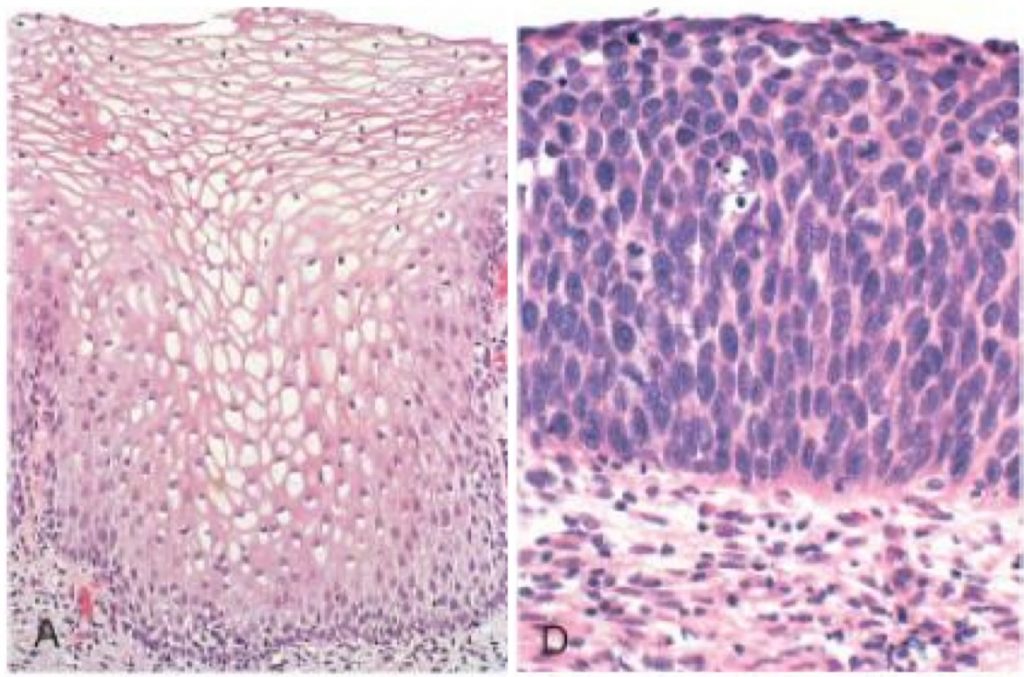 Metaplasia and dysplasia: Video, Anatomy & Definition