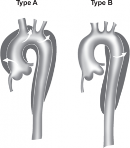 Bilderesultat for stanford aortic dissection