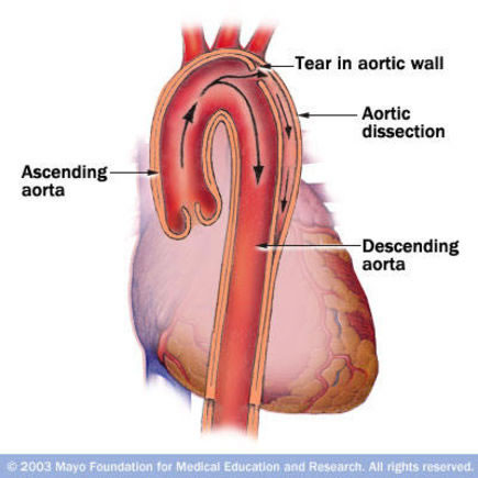 http://aorticdissection.com/wp-content/gallery/ad-pics/mayo.jpg