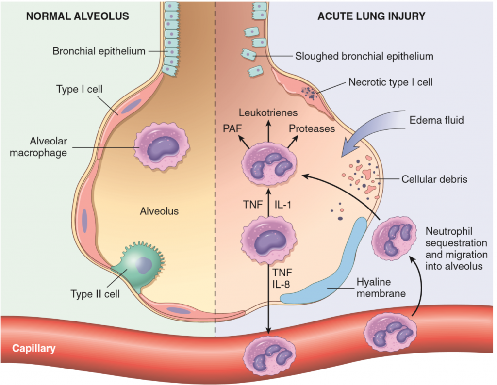 atelectasis alveoli