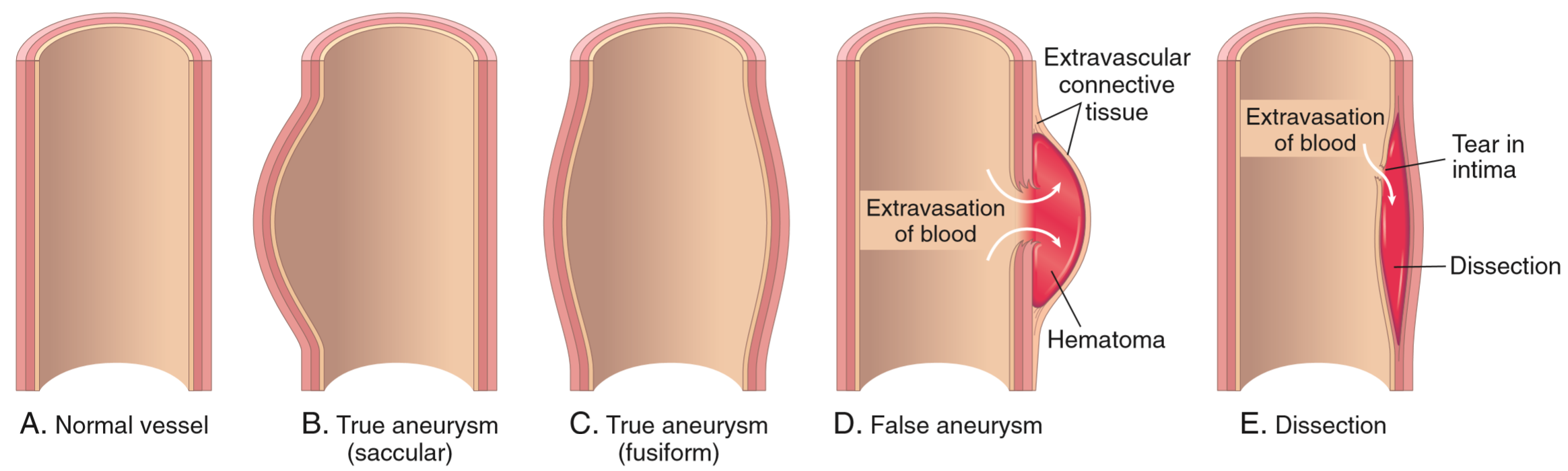 57-types-and-clinicopathology-of-the-aneurysms-greek-doctor