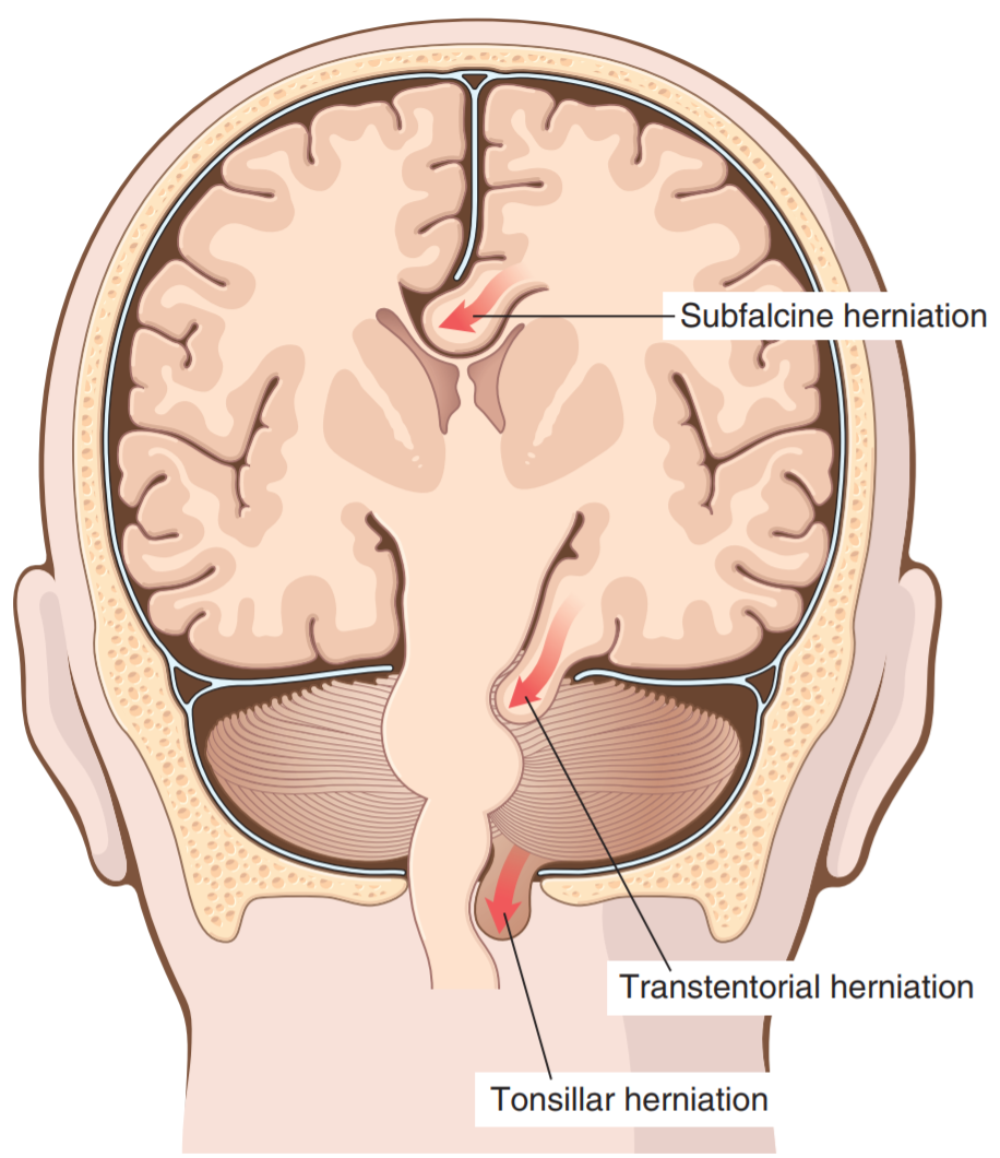 35. Cerebral edema, hydrocephalus, malformations of the brain – greek