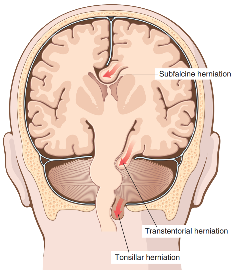 35 Cerebral Edema Hydrocephalus Malformations Of The Brain Greek 