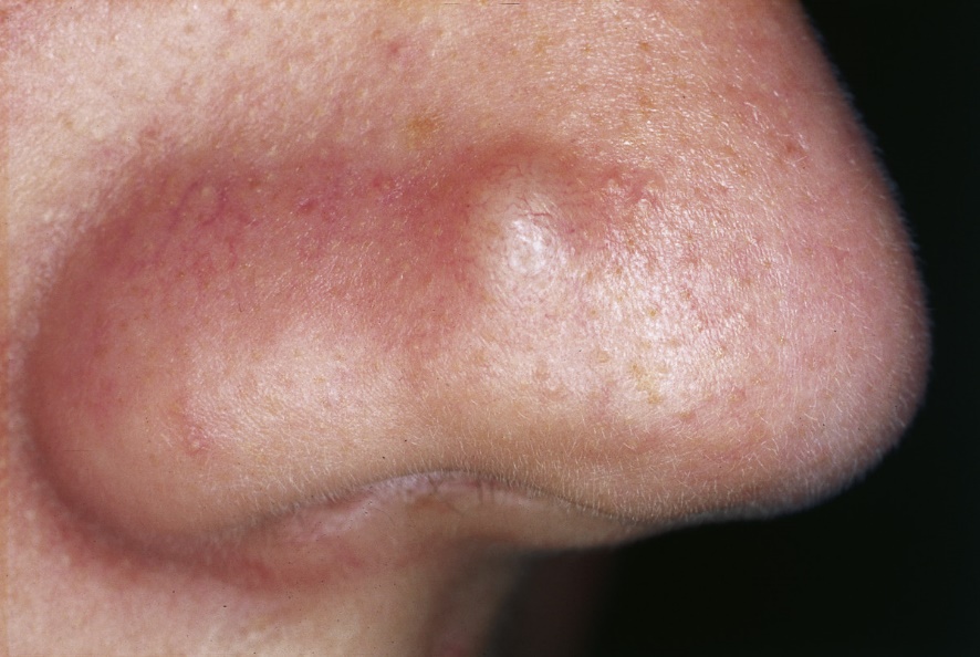 Fibrous papule of the nose 01.jpg