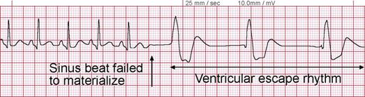 http://www.medicine-on-line.com/html/ecg/e0001en_files/image092.png