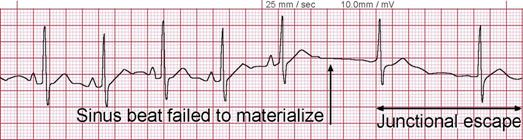 http://www.medicine-on-line.com/html/ecg/e0001en_files/image082.png