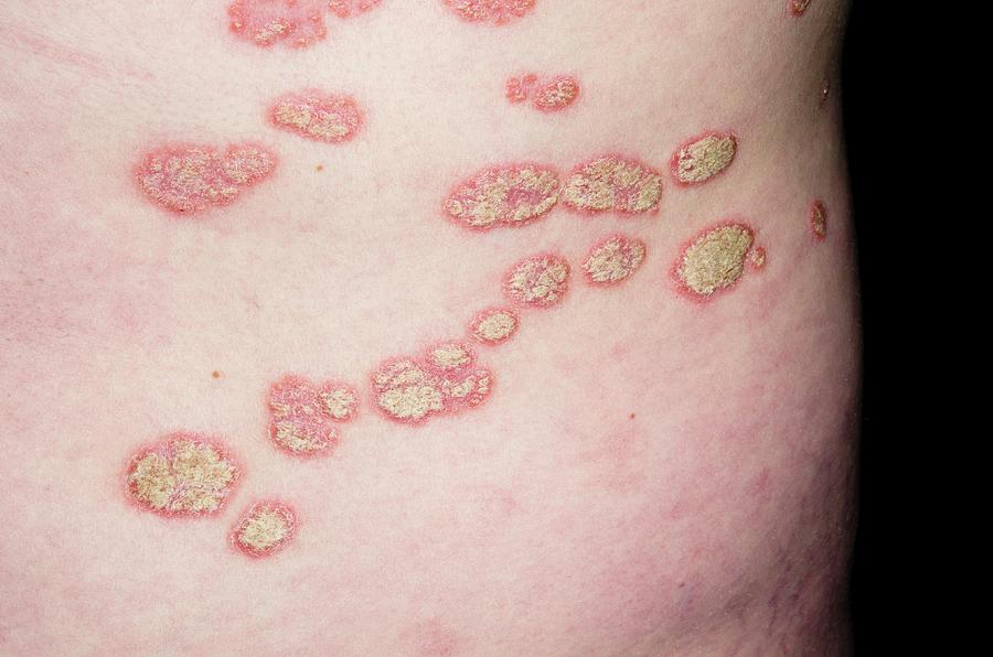 https://images.fineartamerica.com/images-medium-large-5/5-plaque-psoriasis-on-the-skin-dr-p-marazziscience-photo-library.jpg