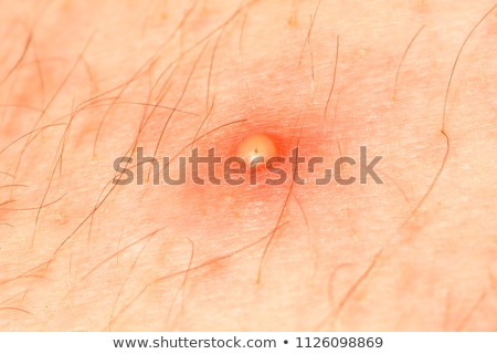 purulent pustule on the skin