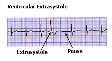 Ventricular extrasystole ECG