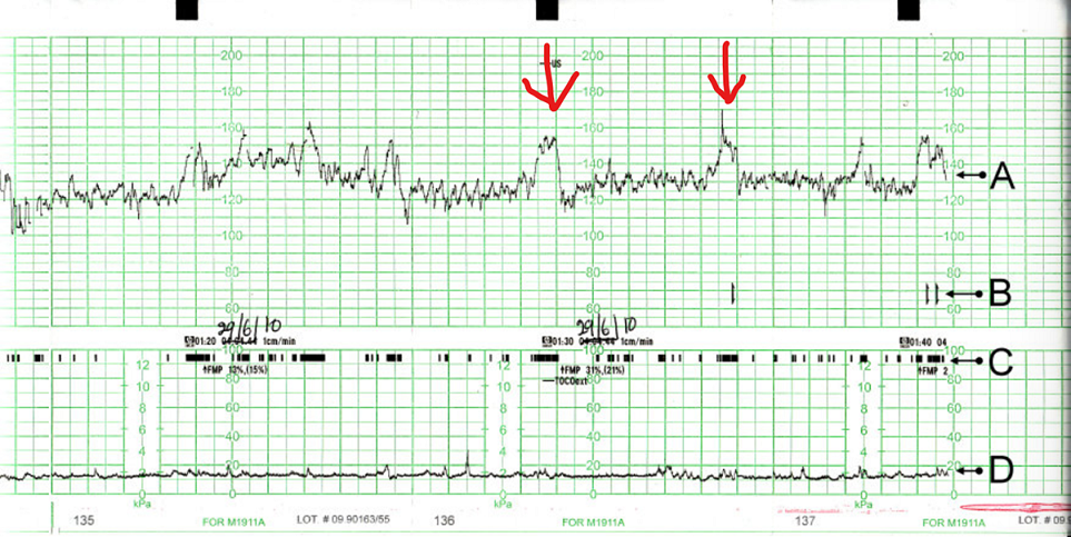 Contraction stress test: How and why it's done