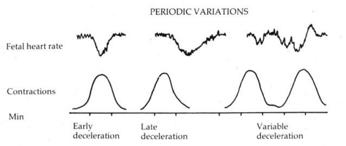 STAN : analyse du segment ST de l'ECG fœtal